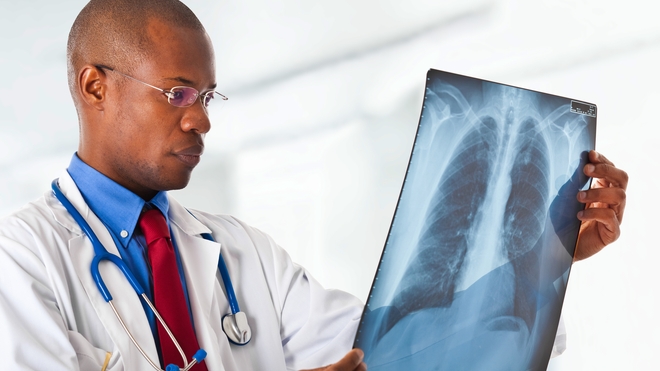 La tuberculose est provoquée par une bactérie qui s'attaque aux poumons