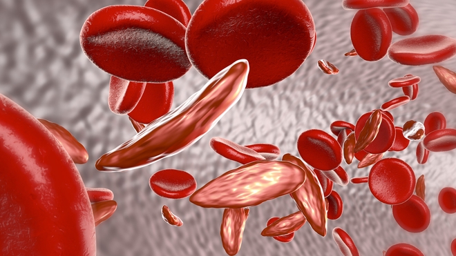 La drépanocytose est également appelée anémie falciforme