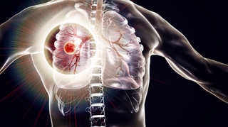 La tuberculose pulmonaire