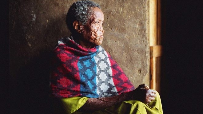 Une personne affectée par la lèpre à Addis Abeba, en Ethiopie