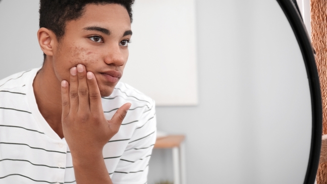 L'acné touche essentiellement les adolescents