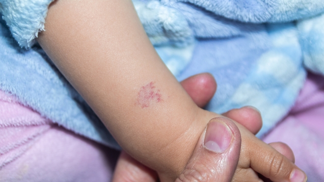 Chez les bébés, l'angiome apparaît dans les jours qui suivent la naissance