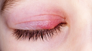 Comment soigner un orgelet ?