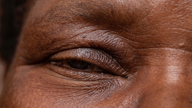 Il y a différentes formes de ptosis