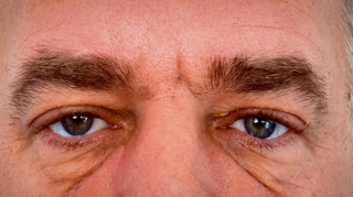 Poches sous les yeux, un signe de maladies ?