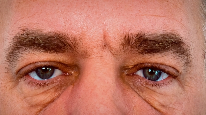 Les poches sous les yeux peuvent apparaître avec l'âge
