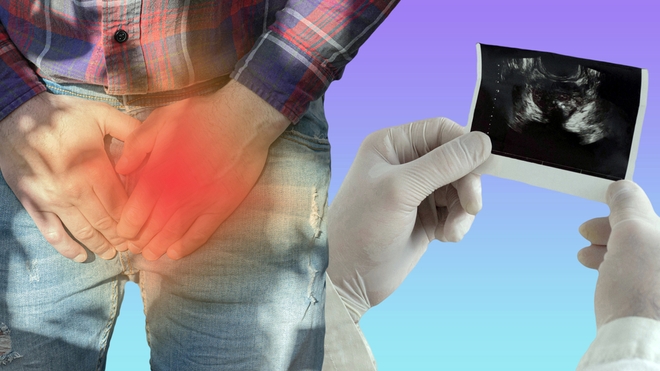 L'adénome de la prostate est bénin