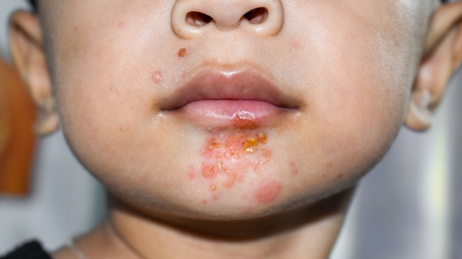 L'impétigo est fréquent chez les enfants 