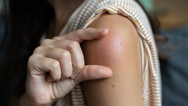 Les effets indésirables les plus fréquents sont une fièvre légère et une rougeur au point d’injection du vaccin
