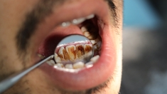 Comment se forme le tartre sur les dents ?