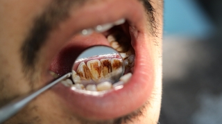 Comment se forme le tartre sur les dents ?