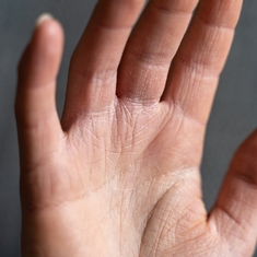 Comment mieux vivre l'eczéma ?