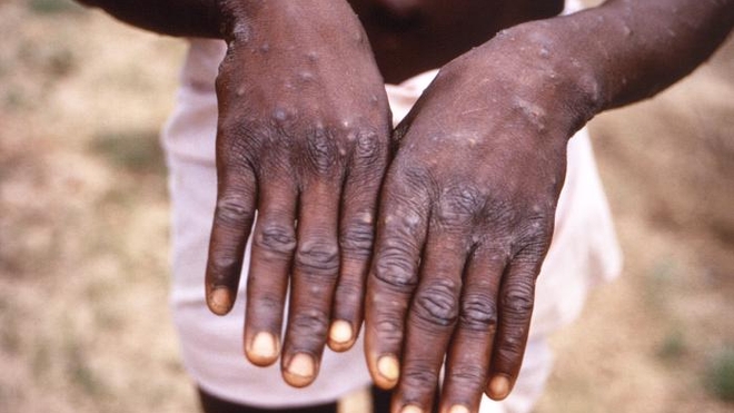 Le premier cas humain de variole du singe a été découvert en République démocratique du Congo en 1970 