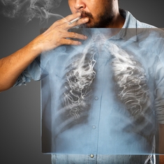 Cinq idées reçues sur le cancer du poumon