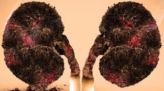 Le cancer du poumon, un fléau au Maghreb