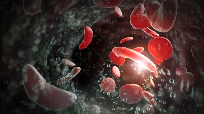 Comment savoir si j'ai la drépanocytose ?
