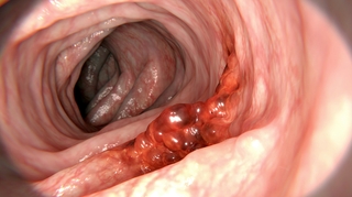 Cancer colorectal : quels symptômes doivent alerter ?