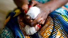 En RD Congo, la détection de la lèpre s'intensifie 