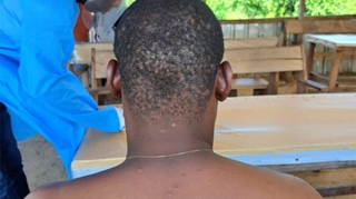 mpox : pourquoi cette nouvelle souche inquiète l'Afrique ?