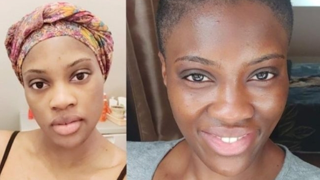 Une femme s'étant dépigmentée la peau (photo d'illustration)