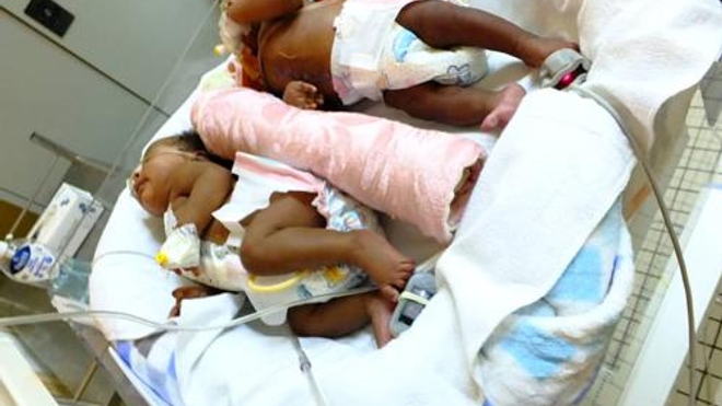 Les bébés siamois ont été séparés avec succès, le 6 octobre dernier