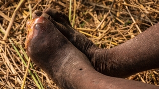 Éléphantiasis, bilharziose... le Sénégal veut venir à bout des maladies tropicales négligées