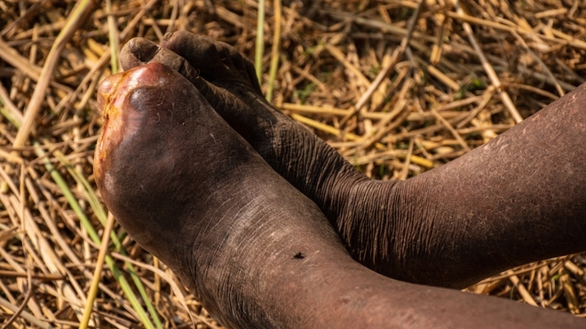 L'éléphantiasis se caractérise le plus souvent par un gonflement des jambes