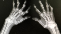 Polyarthrite rhumatoïde, la maladie qui s’attaque aux articulations 