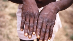 Variole du singe : la nouvelle souche gagne du terrain en RD Congo