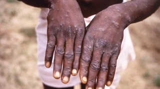 Variole du singe : la nouvelle souche gagne du terrain en RD Congo