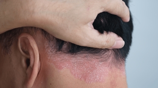 Comment se débarrasser du psoriasis du cuir chevelu ?