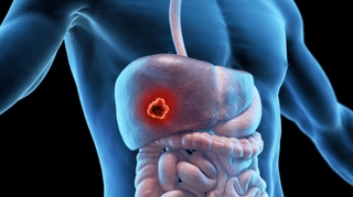 Dépister et prévenir le cancer du foie