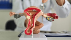 Ligature, salpingectomie... tout savoir sur la contraception définitive chez les femmes