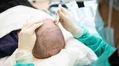 Implants capillaires : quels sont les risques d'une greffe de cheveux ?