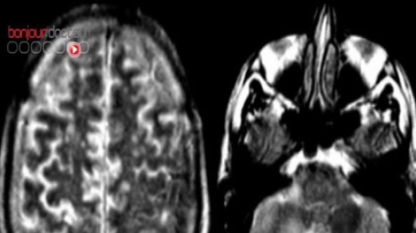 Alzheimer, la taille du cerveau en question