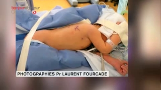 Chirurgie robotique sur un nouveau-né : une première européenne