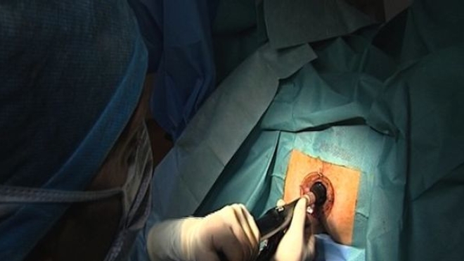 Hémorroïdes : « La chirurgie doit être le dernier recours »