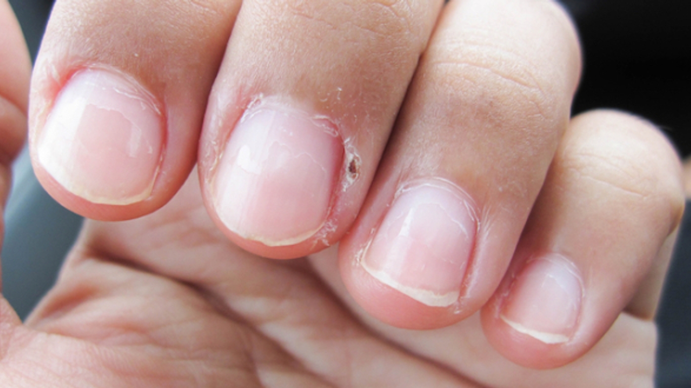 Mycoses des ongles : le traitement au laser - Allô Docteurs 