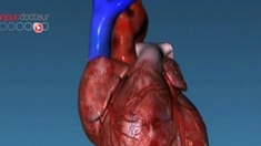 Le coeur des hommes génétiquement prédisposé à l'infarctus