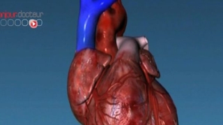 Le coeur des hommes génétiquement prédisposé à l'infarctus