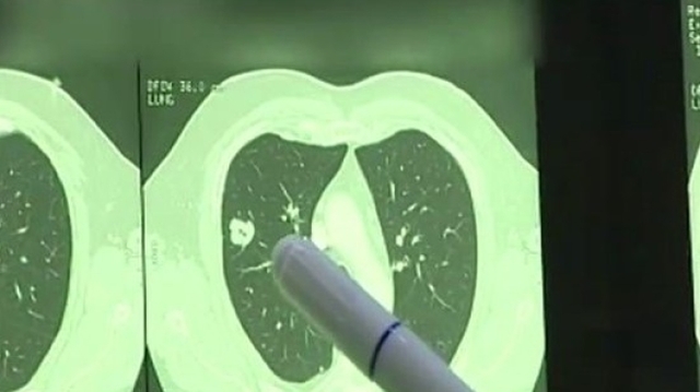 Nodule pulmonaire : une tache sur les poumons