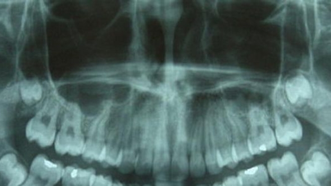 Plus de tumeurs au cerveau avec des radiographies dentaires régulières ?