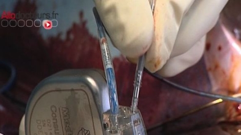 Le pacemaker du futur : plus petit et sans pile