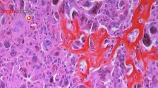 Cellules cannibales, un espoir dans le traitement du cancer du pancréas