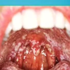 Candidose buccale : quand la mycose infecte la bouche