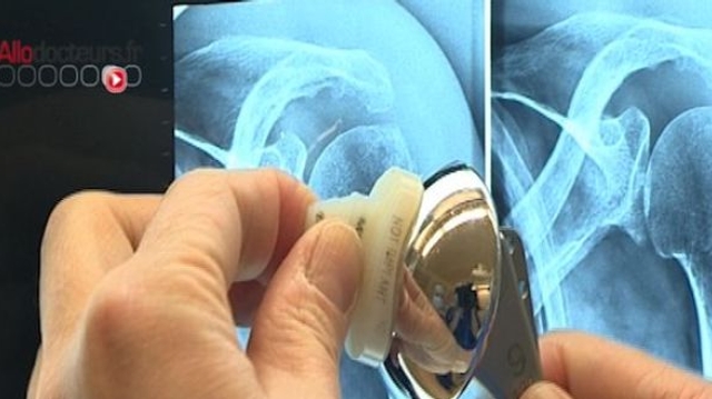 Implants médicaux : une enquête internationale dénonce d'importantes lacunes dans les contrôles