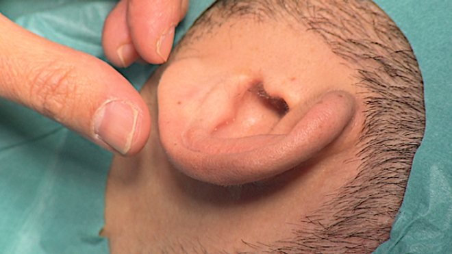 Réparer les malformations de l'oreille