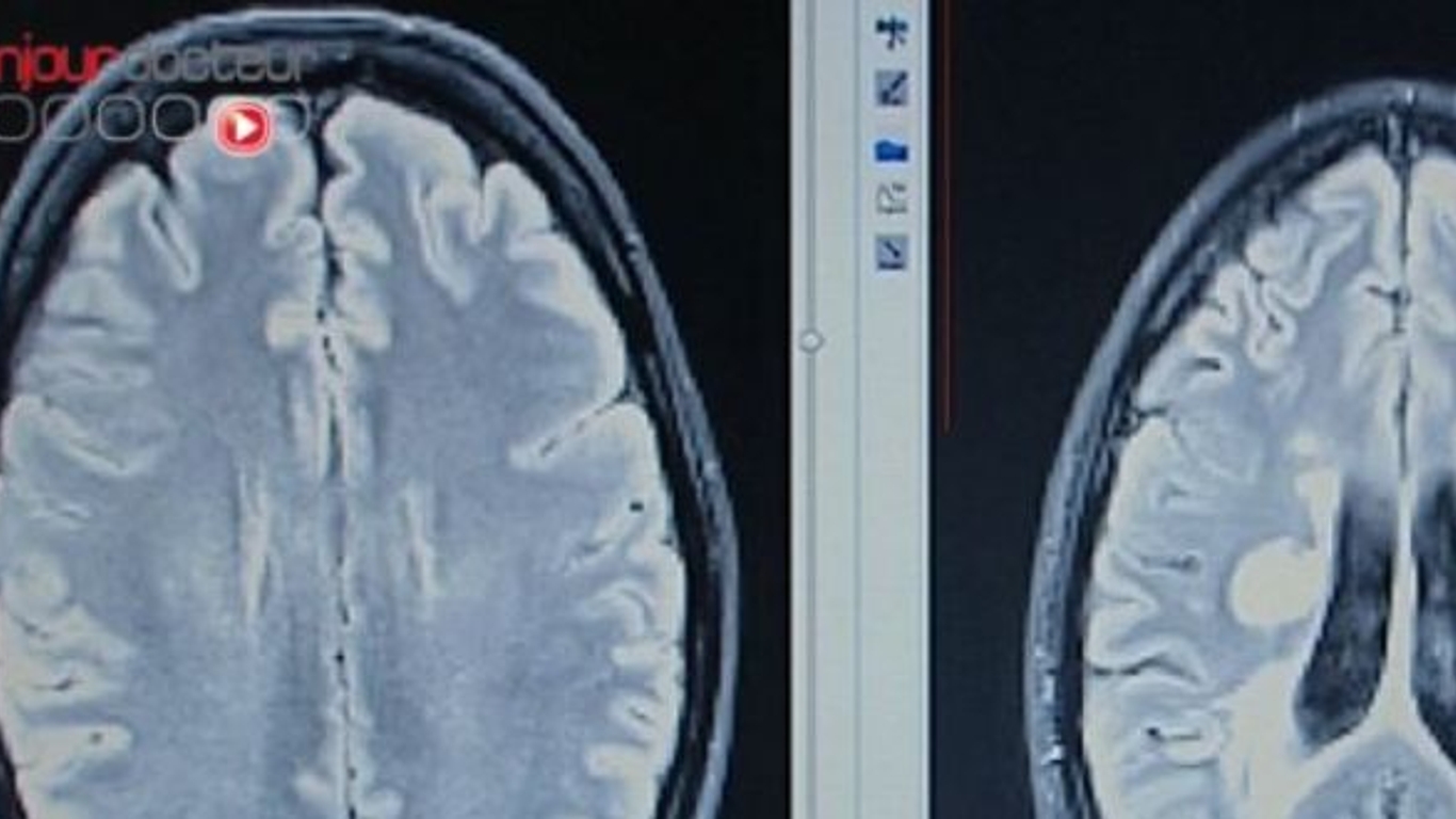 Cerveau : les taches blanches n'ont rien à voir avec les migraines ...