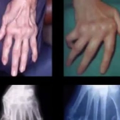 Polyarthrite rhumatoïde : les mains et les poignets en première ligne