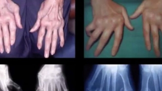 Polyarthrite rhumatoïde : les mains et les poignets en première ligne